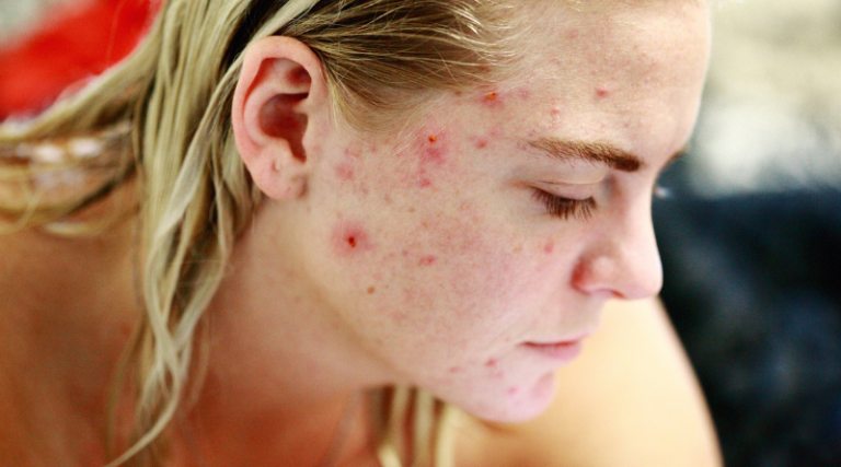 Person with acne